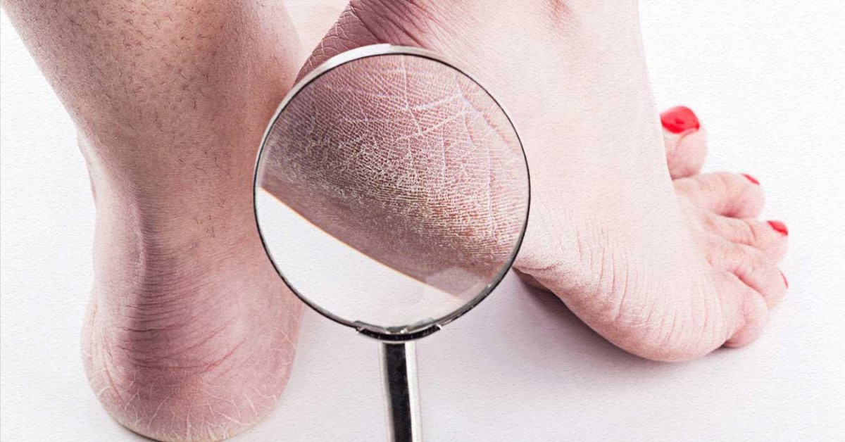 Kalınlaşmış Topuk Bakımı