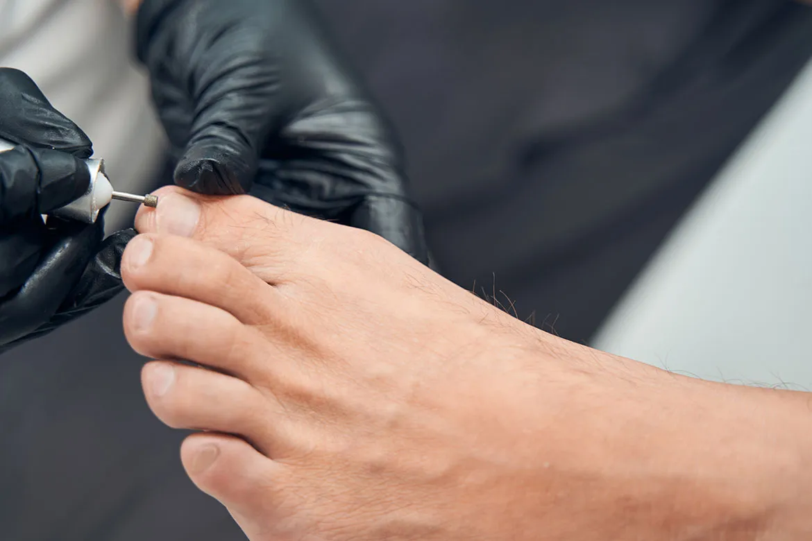 Kalınlaşmış ve Sararmış Tırnak Bakımı